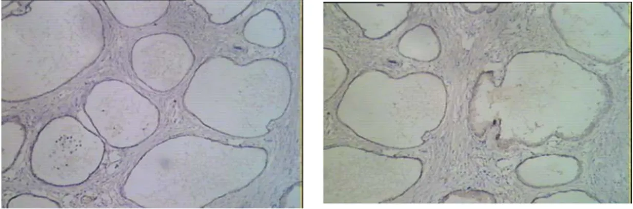Gambar 1.  Hiperplasia Prostat Pulasan dengan   Gambar 2.  Hiperplasia Prostat Pulasan 