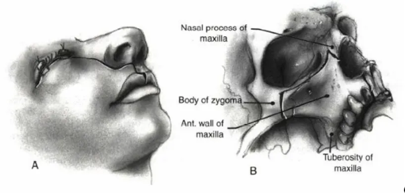 Gambar 7. A. Pola incisi Weber-Ferguson, B. Pola limited atau partial maxillectomy 15