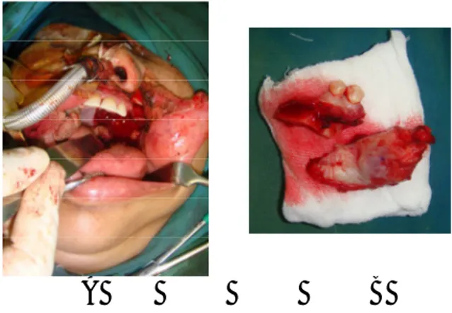 Gambar  4:  A.  Gambaran  pengangkatan  tumor  dengan  hemimaksilektomi  pada  palatum  kiri