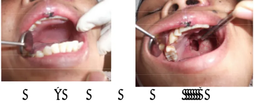 Gambar 6.  A. Menunjukkan gambaran klinis POD XI  setelah pembuatan obturator. B. Gambaran  intraoral setelah obturator dilepaskan