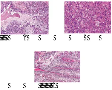 Gambar  6.  A.  Low-grade  Mucoepidermoid  carcinoma,  B.  High-grade  Mucoepidermoid  carcinoma, C.Intermediate-grade Mucoepidermoid carcinoma