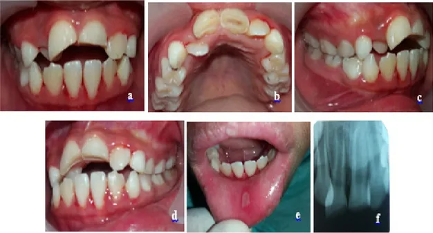 Gambar 1.  a. fraktur mahkota dengan keterlibatan dentin gigi 11 dan 21, b. dentin yang terlibat pada fraktur  11 terlihat ketebalan dentin &gt; 0,5 mm dan pada 21 terlihat berbayang kemerahan, tanpa perdarahan, c
