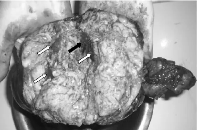 Gambar 4. Gambaran makroskopis massa tumor. Tampak sebagian besar berupa massa solid dan beberapa diantaranya berupa kistik (panah putih)