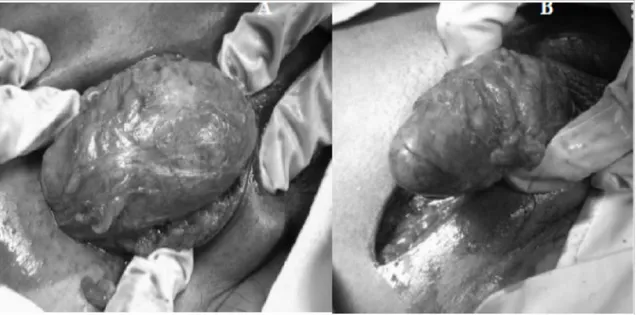 Gambar 5. Hasil temuan operasi: A. Massa tumor setelah kulit diinsisi. B. Pembebasan tumor dari jaringan  sekitarnya