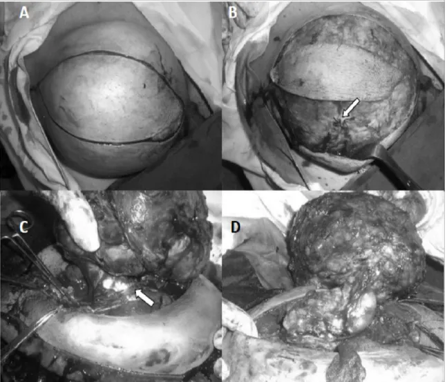 Gambar  3.  Hasil  temuan  operasi: A.  Insisi  elips  diatas  dan  sepanjang  massa  tumor