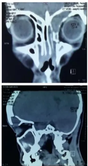 Gambar 2.  CT  Sinus  Paranasal.  A.  Potongan  koronal, tampak erosi pada dinding sinus frontal kiri B
