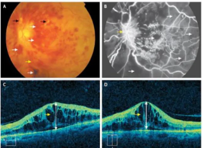 Gambar  4.  Gambar  A;  Foto  fundus  memperlihatkan  perdarahan intra retina yang luas (panah putih), cotton  wool  spot  (panah  hitam),  edema  pada  diskus  optikus  dan  hiperemia,  dilatasi  vena  yang  berkelok-kelok  (panah  kuning)
