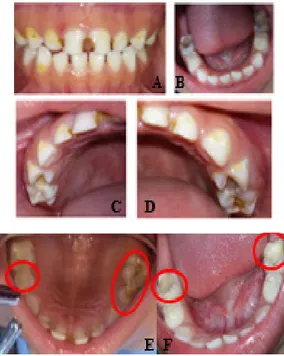 Gambar 1. Foto Intraoral (A-D) Kunjungan Pertama  Tanpa Kaca Intraoral Menunjukkan Multiple Caries  Hampir di Seluruh Gigi