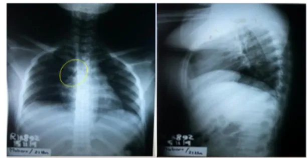 Gambar 4. Rontgen Thorak PA dan Lateral. 