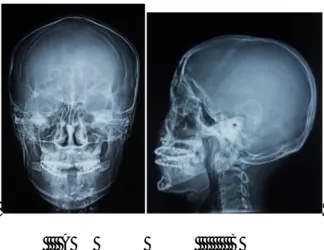 Gambar 7. A. Gambaran rontgen schedel AP dari pasien 1 bulan post ORIF elektif. B. Gambaran  rontgen lateral  pasien 1 bulan  post ORIF elektif