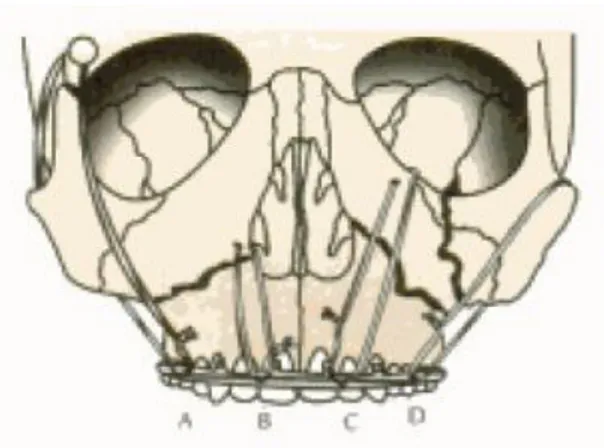Gambar 10 . Gambaran berbagai macam teknik suspensi. A. Frontal bone suspension, B. Pyriform  rim suspension, C