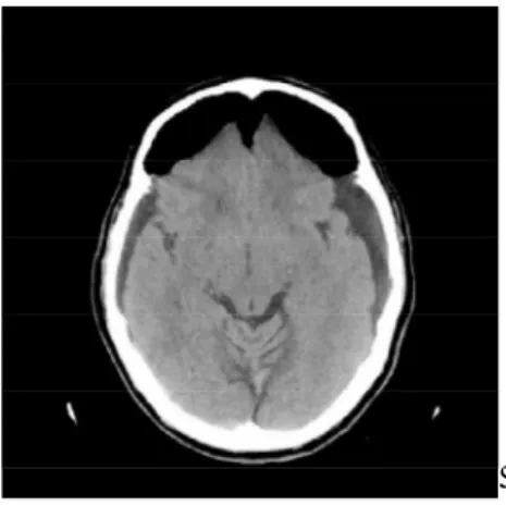 Gambar 11. Gambaran CT Scan menunjukkan fenomena Mount Fuji pada pasien dengan tension  pneumocephalus 6 
