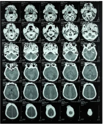 Gambar 4. Gambaran CT Scan potongan coronal, tampak fraktur sinus frontalis aspek anterior dan  posterior,  serta pneumocephalus pada bagian frontal