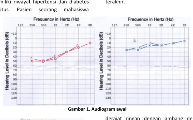 Gambar 1. Audiogram awal 