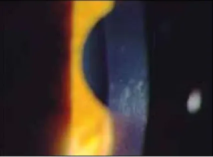 Gambar 6.  Fleicher’s ring  2 