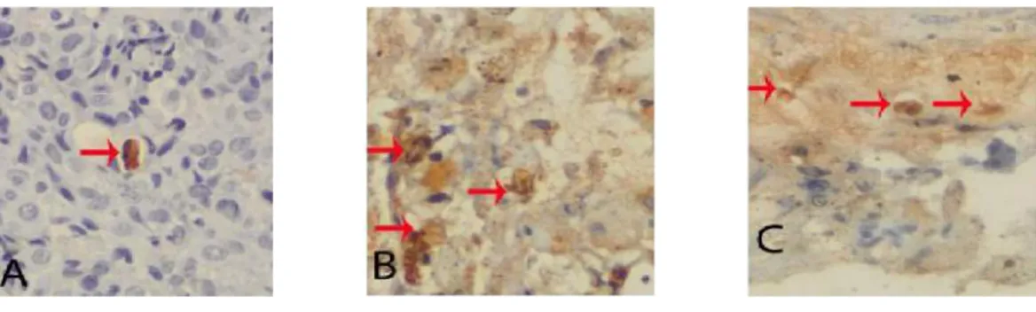 Gambar 3. Pengecatan IHC cleaved caspase 3 sampel biopsi serviks. Pengecatan pre NAC tampak ditemukan sedikit aktifitas caspase 3 (A) bila dibandingkan dengan post NAC ke 1 (B) dan post NAC ke 4 (C).