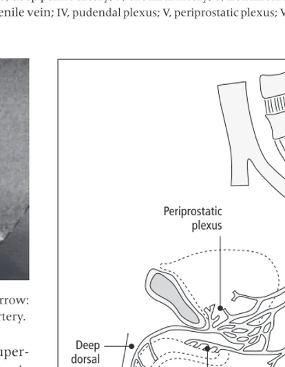 Fig. 3.1 Arterial and venous supply of the penis. Circulation: 1, internal pudendal artery; 2, superﬁcial perineal artery; 3,penile artery; 4, bulbar artery; 5, dorsal penile artery; 6, deep penile artery; 7, urethral artery; 8, helicinearteries; I,superﬁcial dorsal vein; II, deep dorsal vein; III, deep penile vein; IV, pudendal plexus; V, periprostatic plexus; VI, circumﬂexveins; VII, emissary veins.