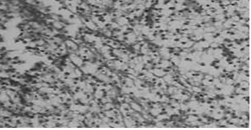 Gambar 2.   Gambaran mikroskopis yang mengindikasikan sekelompok sel-sel negative pada pewarnaan   PAS  (Habibi dkk