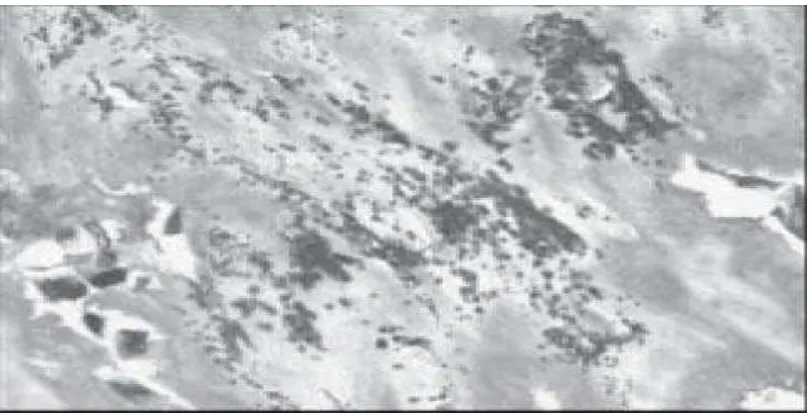 Gambar 4.    Gambaran yang menunjukkan  eosinofilik  aselular berubah menjadi nodul dengan pe- ngkalsifikasian yang ekstensif (Shanmuga dkk