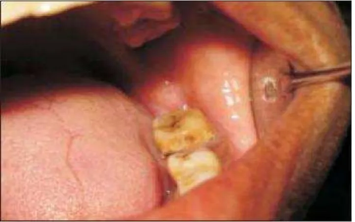 Gambar 6.      Pandangan    intra oral  (Thomas dkk. J.indian academy of oral medicine      and Radiology 2008;20:29) 15 