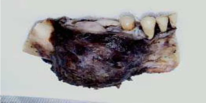 Gambar 13.   Gambaran  makroskopis  dari specimen  tumor tereseksi (Palau  dkk. Rev                          Esp Cir Oral  y Maxillofacial 2007;29:344) 9  