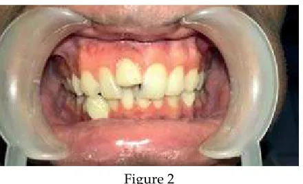 Figure 1Labially misaligned crown fracture due to 