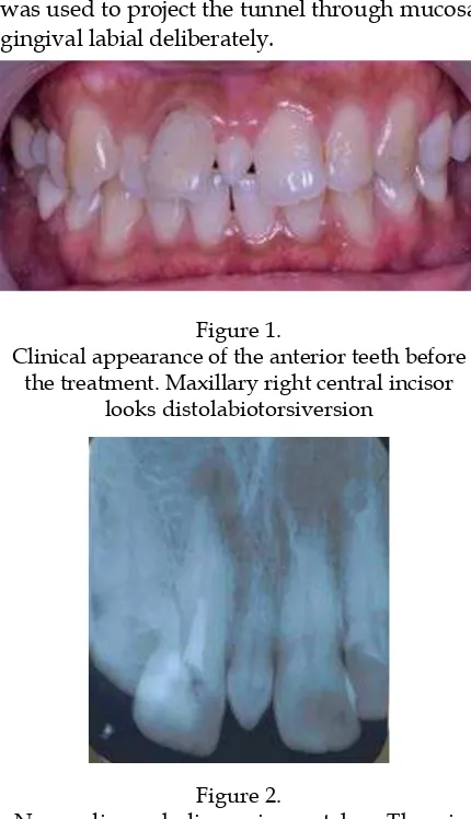 Figure 1.Clinical appearance of the anterior teeth before 