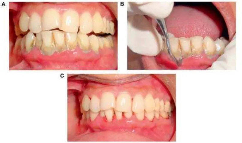 Gambar 2.1 Keadaan gigi dan gusi: A. Sebelum proses scaling, B. Saat 