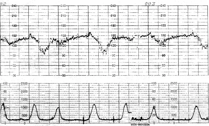 Fig 4 Deselerasi Lambat