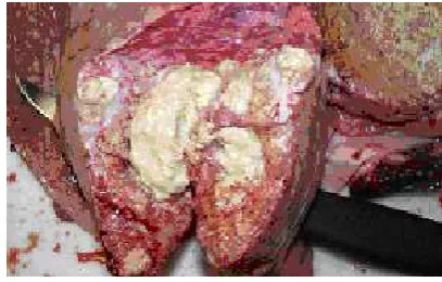 Gambar 1. Lesi Tuberkulosis pada paru 