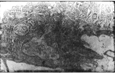 Figure 3. acinus gland underwent squamous metaplasia and the surrounding tissue was heavilly infiltrated by inflam- Salivary glands in the posterior oropharyngeal area of rat fed 10% protein salted fish