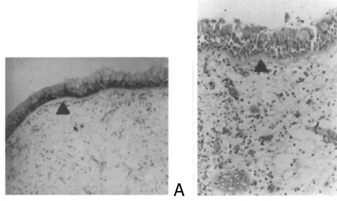 Gambar 1. A. Edematous, Eosinophilic Polyp. Terdapat banyak sel-sel inflamasi, paling banyak adalah eosinofil dan sel mast