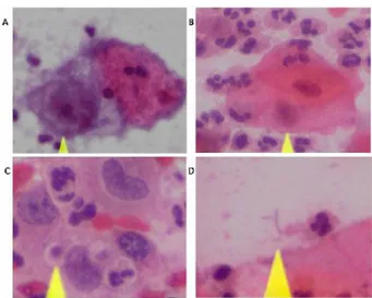 Gambar 2. Gambaran hasil pemeriksaan Pap smear pada infeksi  bakteri  vagina  (A),  infeksi 
