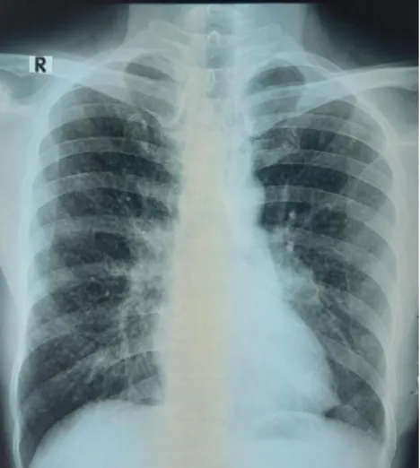 Gambar 2. massa paru lobus inferior kiri                     dengan metastasis tipe milier 