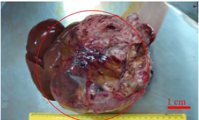 Gambar 2 Bidang sayatan massa tumor, ditemukan         pendarahan pada bagian tengah.  