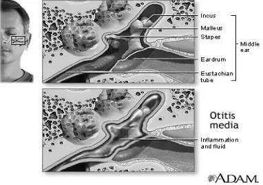 Gambar 2.4. Otitis Media Akut (OMA) (sumber: Adaptasi dari Kaneshiro, N. K., 2010. Ear Infection – Acute Images: Middle ear infection 