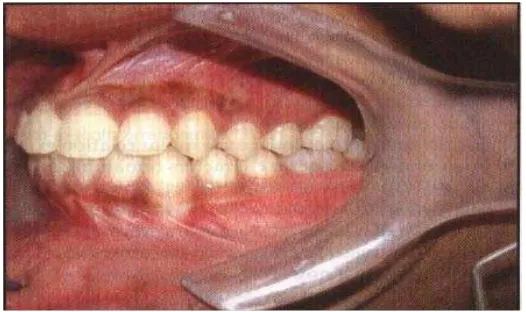 Gambar 1. Relasi molar pada maloklusi Klas I Angle. 2 
