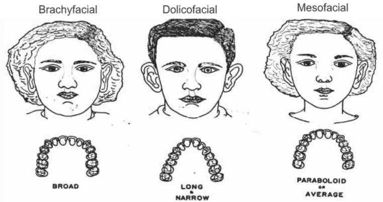 Gambar 1. Hubungan antara bentuk wajah dengan bentuk lengkung gigi.7  dengan pencabutan empat gigi premolar pertama