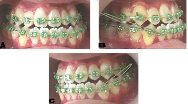 Gambar 6. Foto ekstra oral pasien setelah perawatan A.Tampak depan, B. Tampak Depan Tersenyum, C