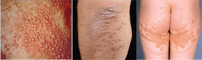 Gambar  2.1. Xantoma eruptif  (Fitzpatrick, 1997) 