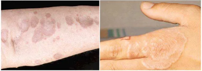 Gambar 2.4.  Granuloma anulare (Fitzpatrick, 1997) 