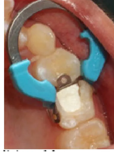 Gambar 5. Foto klinis gigi 65 setelah di beri semen  zinc fosfat.