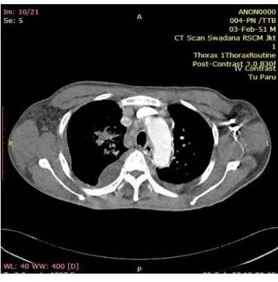Gambar 2.3. Citra Grayscale CT scan Paru (sumber : RSCM, 2011) 