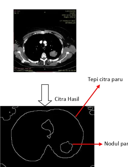 Gambar 2.5 (a) Citra CT Scan Paru  (b) Citra Hasil Dengan Operator Canny 