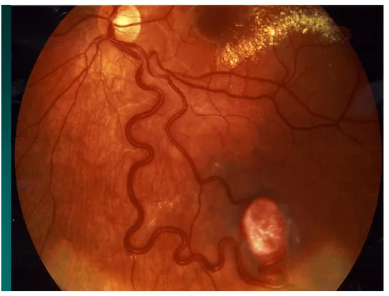 Gambar 5.5. Kuadran Pada Retina Fundus  (Bowling, 2016) 