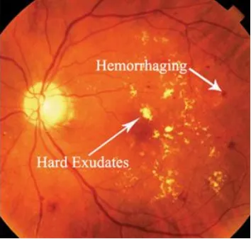 Gambar 6.3. Contoh Citra Fundus NPDR  