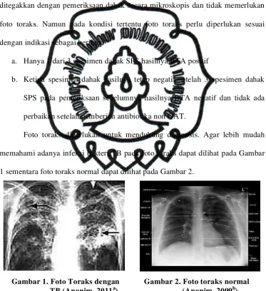 Gambar 2. Foto toraks normal  