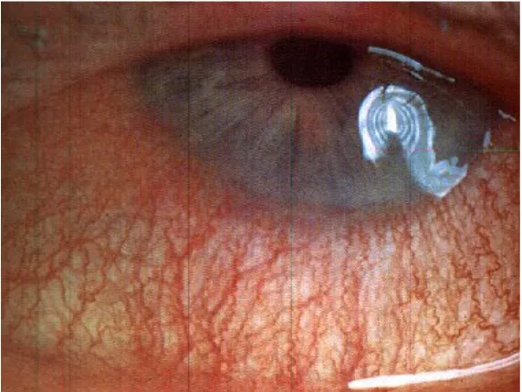 Gambar 3. Dry eye sindrome