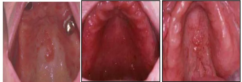Gambar 1. Gambaran klinis denture stomatitis 