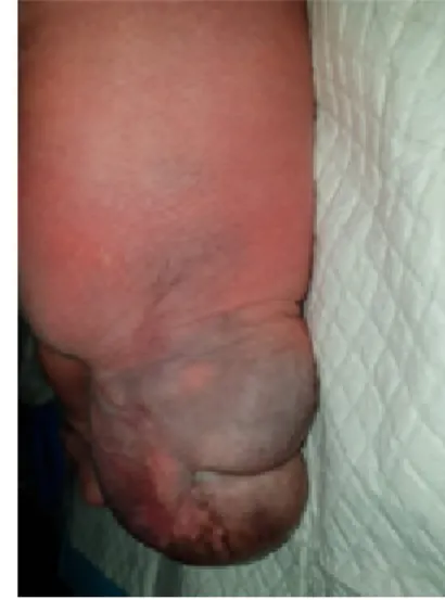 Gambar   2    Bayi dengan teratoma sakrokoksigeuss